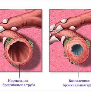 Natural Cure For Lung Infection - Ways To Cure Bronchitis