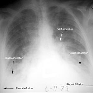 Mucus In Lungs - Causes Of Bronchitis