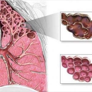 Asthma Cough Cure - How To Diagnose Chronic Bronchitis