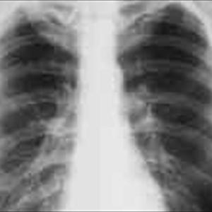 Silver To Cure Bronchitis - How To Identify Longterm Bronchitis