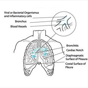 How To Calm Bronchitis - Caring Within My Sister