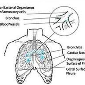 Symptoms Of Serous Bronchitis - Recognizing The Particular The Signs Of Infant Bronchitis