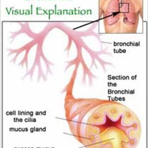 Bronovil Remedy - Acute Bronchitis