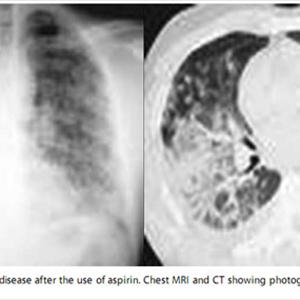 Bronchitis Chest Pain Antibiotics - COPD - The Simplest Way Handle Serious Obstructive Lung Sickness