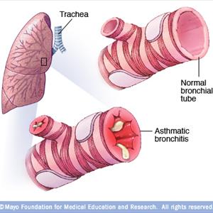 Alternative Medicine For Chroic Bronchitis - Tracheal Bronchitis