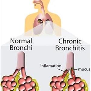 Broncitus - Bronchitis Relief